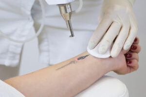 Tatuagem removida a laser (Foto: Reprodução)