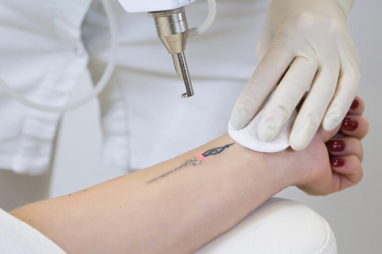 Tatuagem removida a laser (Foto: Reprodução)