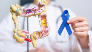 Cuidados com tumor colorretal (Foto: AI)