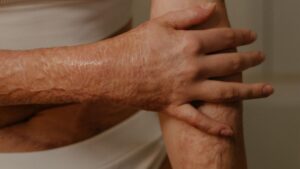 Queimadura de pele (Foto: Pexels)