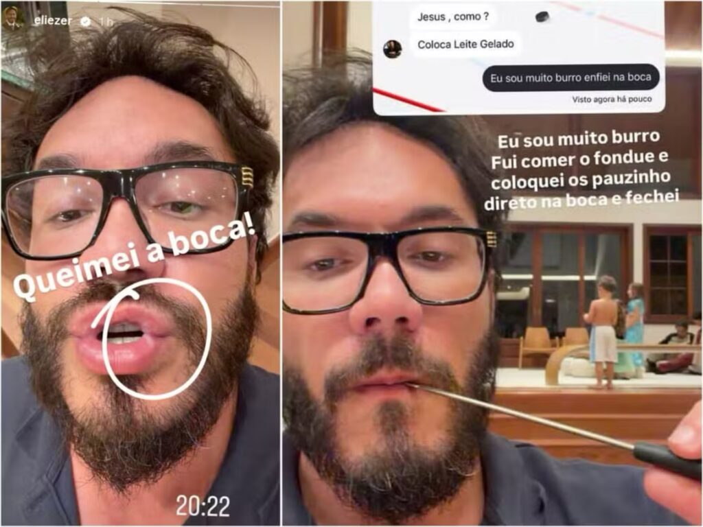 Eliezer mostra queimadura na boca (Foto: Instagram)